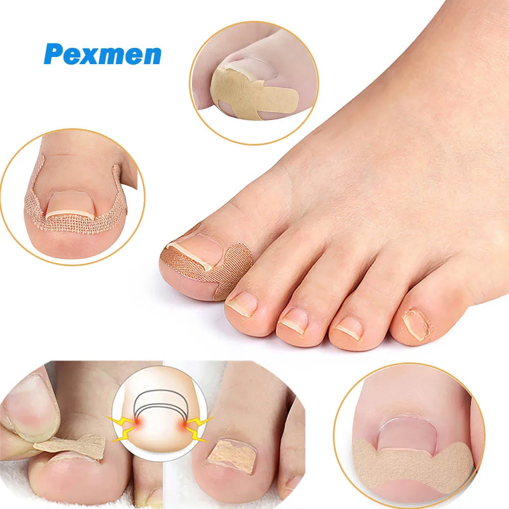 Pexmen 4/20/30/50Pcs Toenail Corrector Patch Nail Patches Ingrown Toenail Corrector Sticker  Keep Nails Healthy cat water fountain filters 16pcs 4 filter keep pets healthy