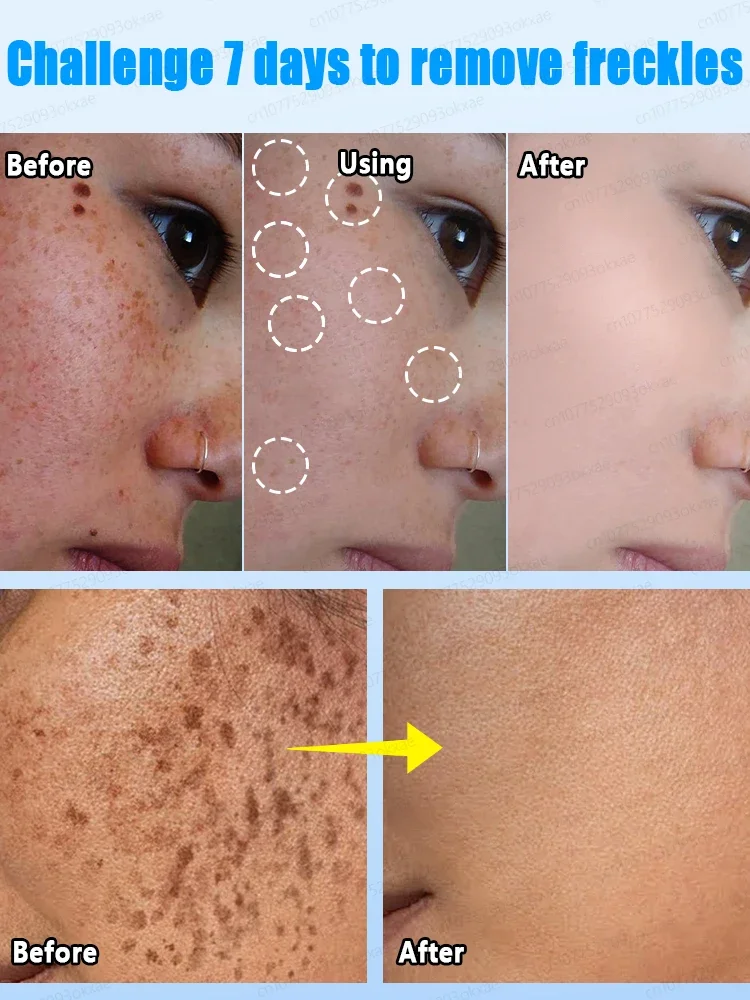 Anti-freckle essence removes dark spots age spots chloasma and freckles in 7 days