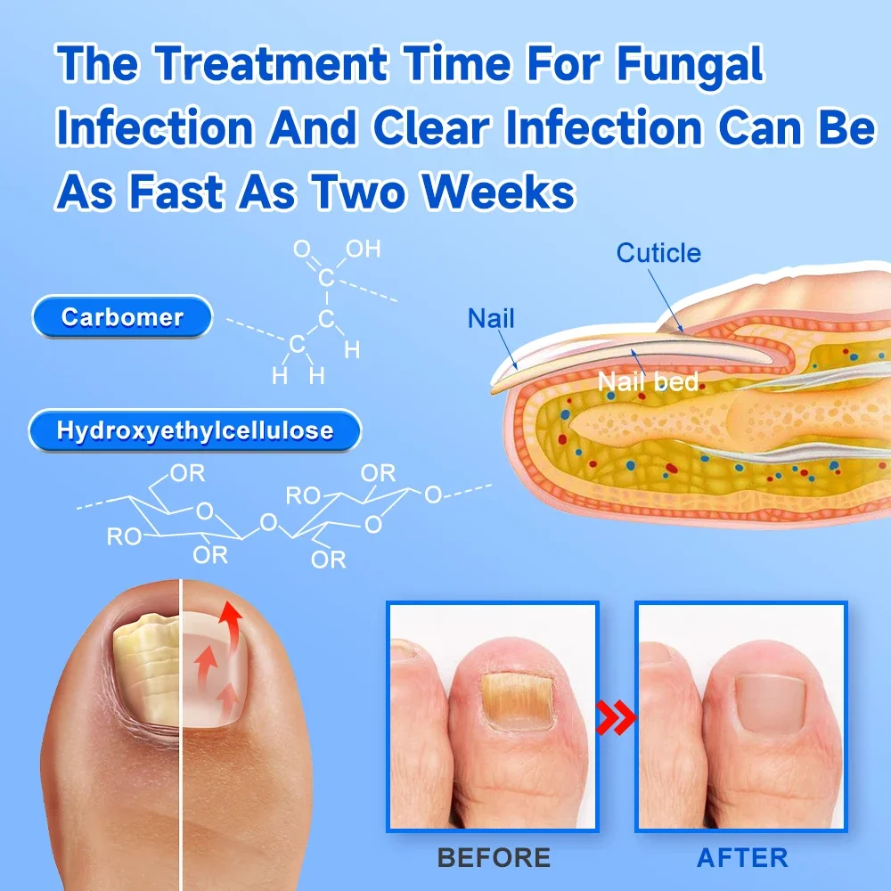Nail Repair Fingernail Device Fast Repair Nails Fungus Onychomycosis For Fingernails Toenails Paronychia Anti Infection Toe Nail
