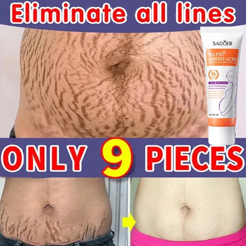 Pregnancy Mark Removal Cream Eliminate Body Belly Stretch Marks Swelling Remove Skin Cracks Repair Firming Care