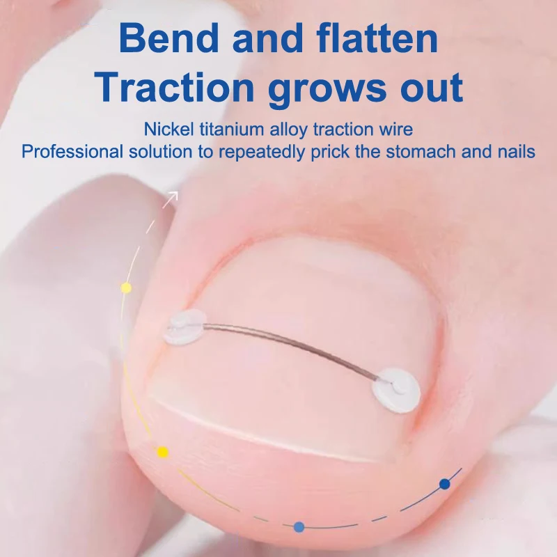 1PC Ingrown Toenail Correction Tool Ingrown Toe Nail Treatment Elastic Patch Sticker Straightening Clip Brace Pedicure Tool toe corrector manicure pedicure tools