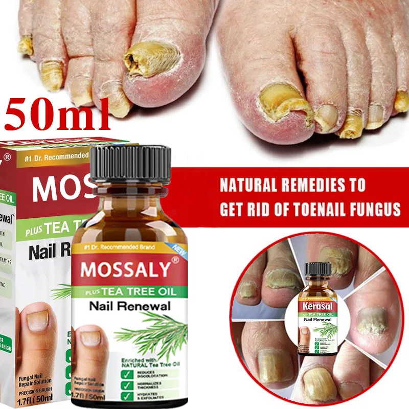 

Nail Fungal Treatment Feet Care Essence Nail Foot Whitening Toe Nail Fungus Removal Gel Anti Infection Paronychia Onychomycosis