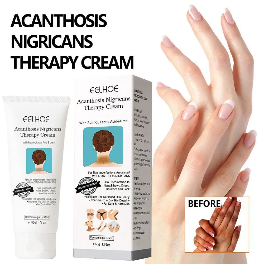 

50ml Acanthosis Nigricans Treatment Oil Removal Face Cream Clears Pimple Scar Black Dots Gel Treat Acne Shrink Pore Whiten Cream