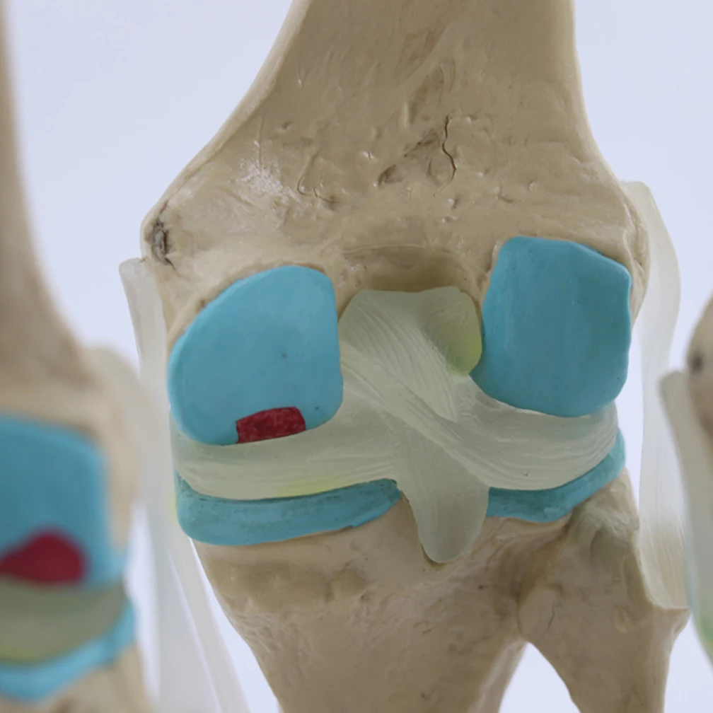Four-Stage Human Pathological Knee Joint Anatomy Model Medical Science Teaching Resources Kit Models Dropshipping