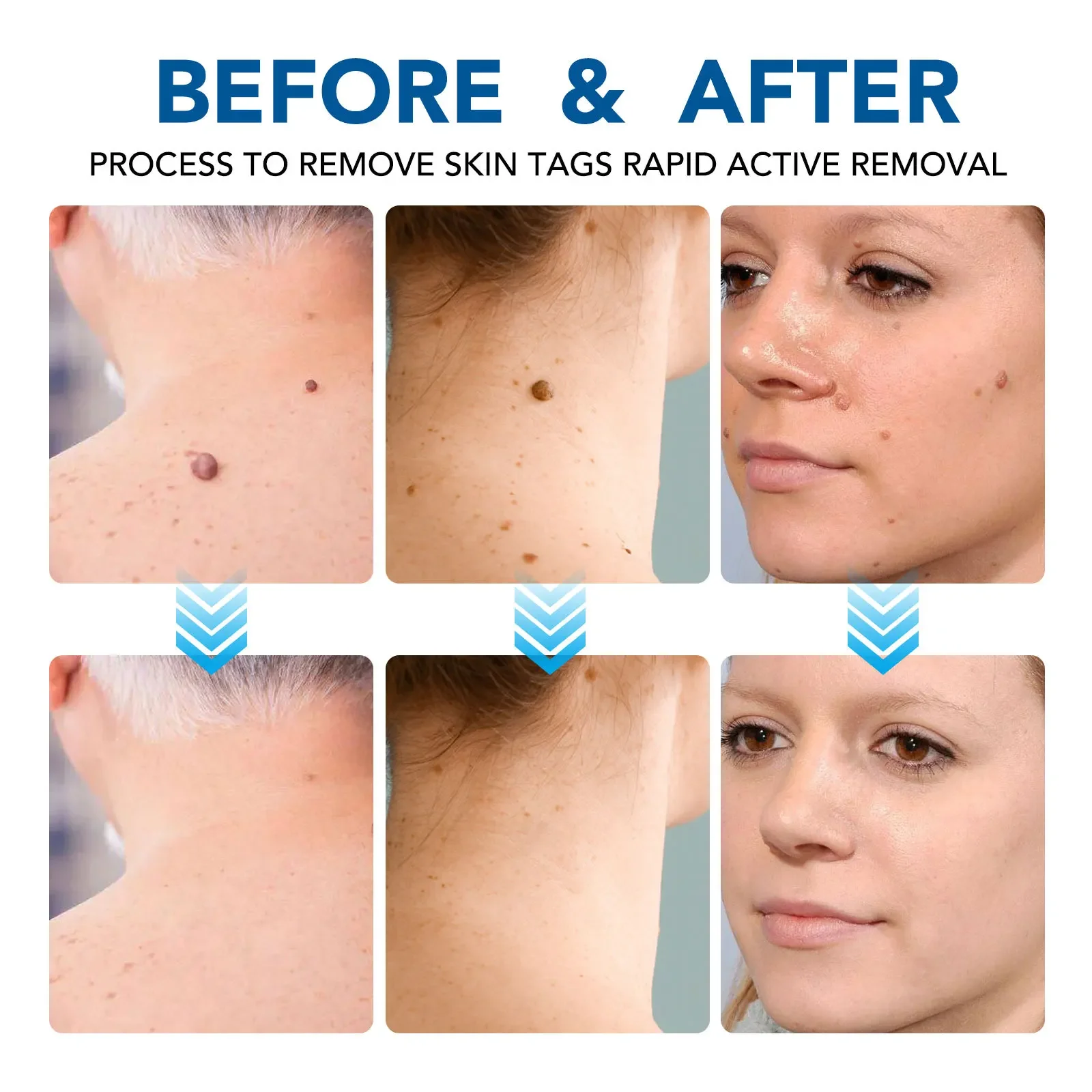 Skin Tag Removal Pen Home Use Painless Safe Skin Tag Mole Wart Spot Removal Equipment for Smooth Skin