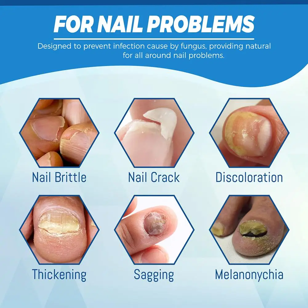 Nail Fungus Treatment Pen Anti-fungal Repair Pen Blue Light Laser Paronychia Nail Onychomycosis Painless Removal Care Tool