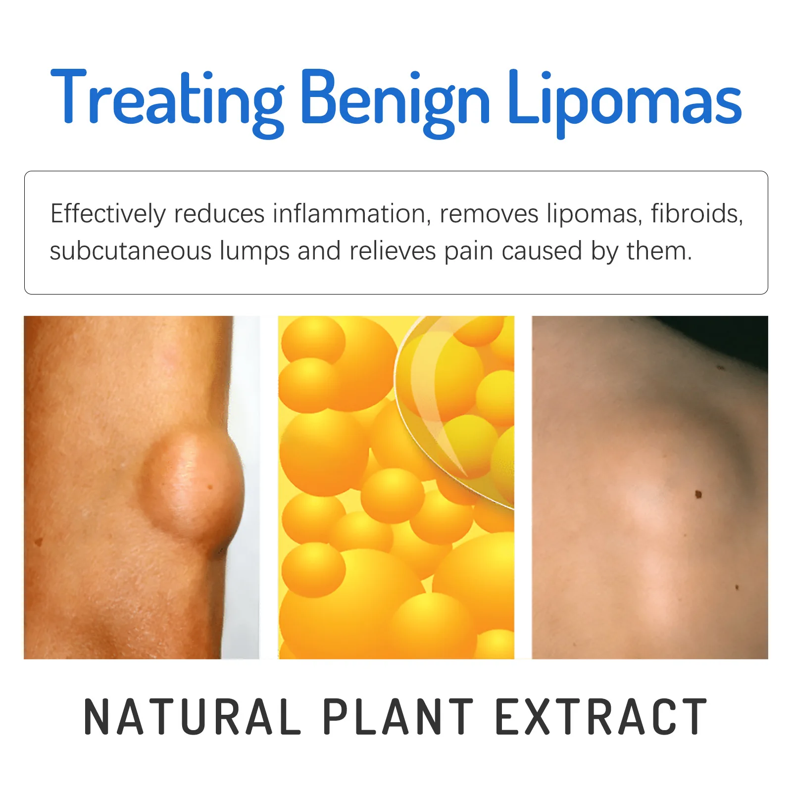 Lipoma Removal Cream Lipolysis Fat Lump Relief Plaster Skin Swelling Fat Elimination Cream Free Shipping 20g Health Care