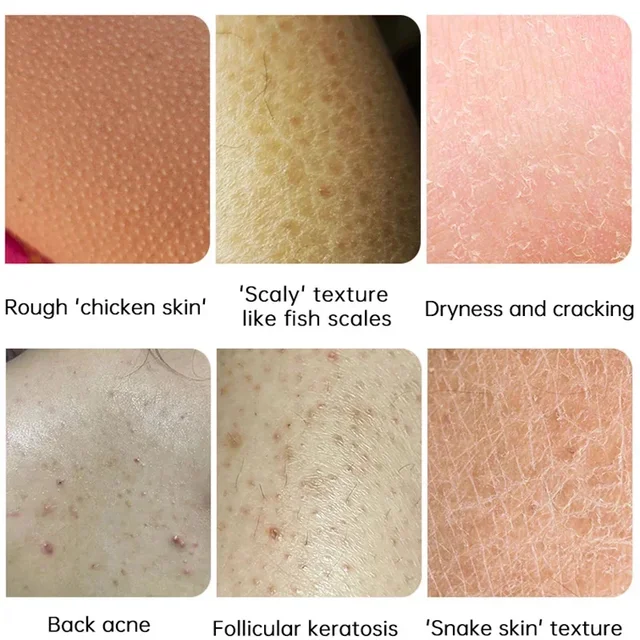 Keratosis Pilaris Cream – Smooth, Clear & Soft Skin