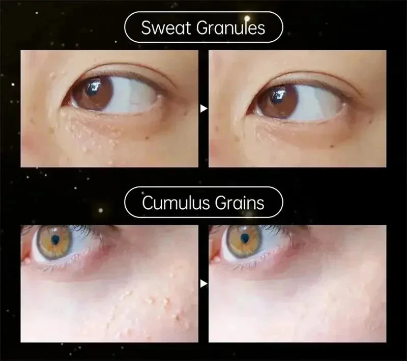Eye Cream for Fat Granules Puffiness - Milia Remover Skin Repair