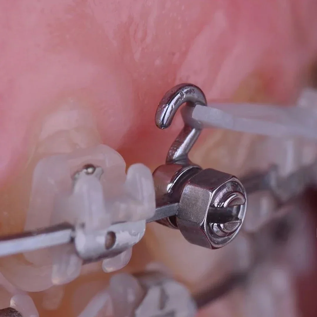 50 Stuks Tandheelkundige Orthodontische Krimpbare Haak Glijdende Kogelhaken Krimpbare Haakstopsloten Verwijderbaar/Activiteit Op Archwires Accessoires