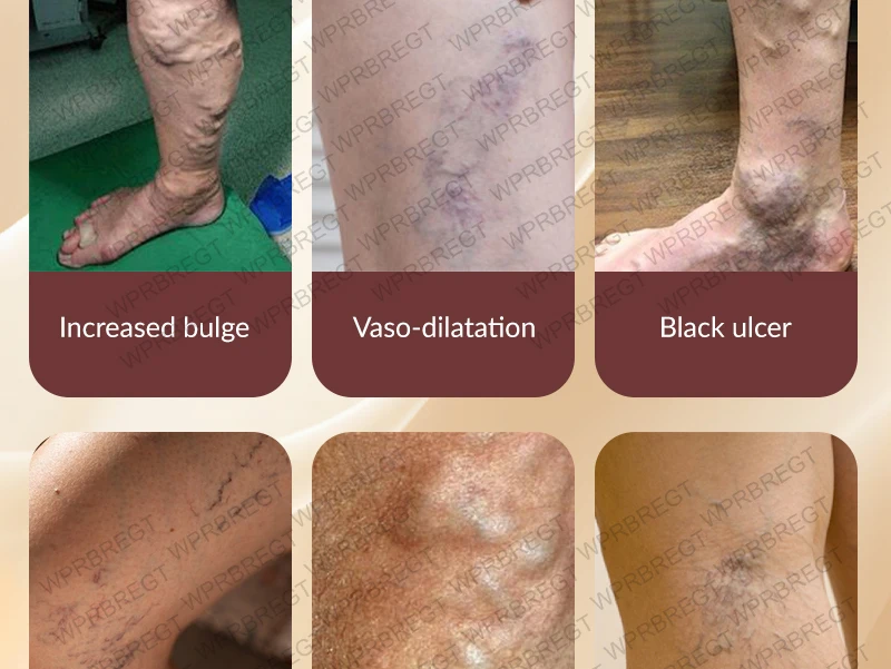 Pulse Massage Patch Eliminates Varicose Veins And Effectively Improves Blood Circulation_voghion.com