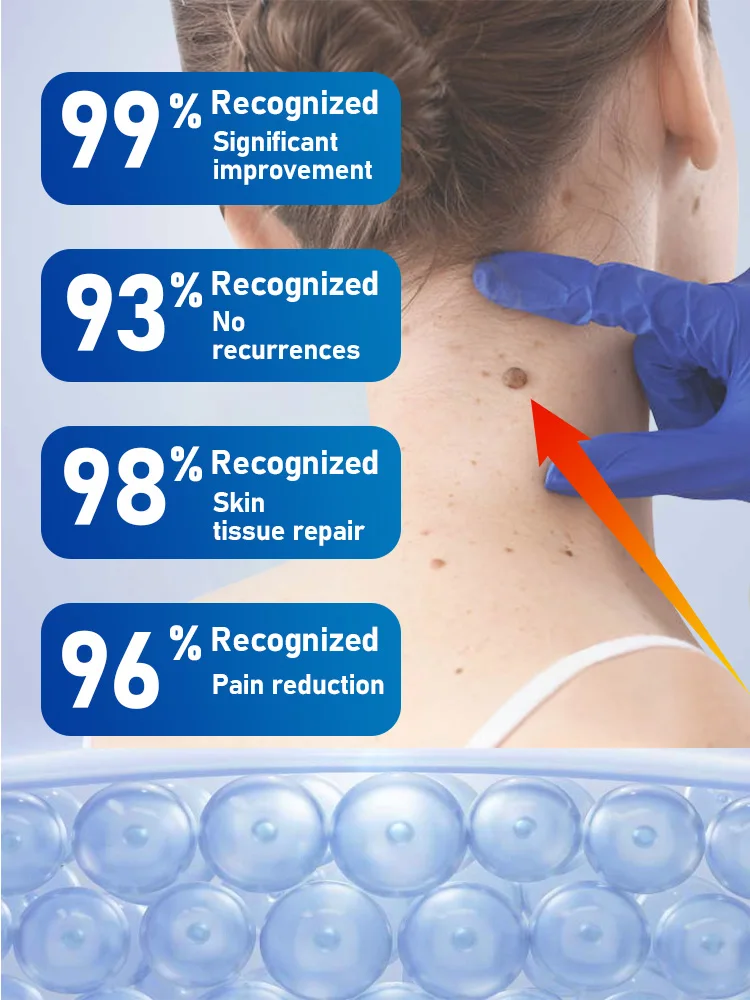 Flacone blu sicuro ed efficace per rimuovere le verruche, strumenti per il corpo, congelamento delle verruche._voghion.com