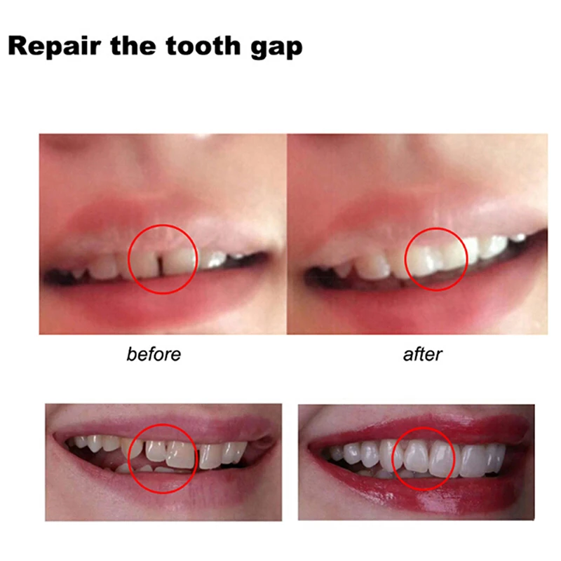 100G Temporary Tooth Repair Kit Thermal Beads Solid Glue Temporary Tooth  Fix for Fake Teeth Veneer Uneven Teeth Beauty Tool - AliExpress