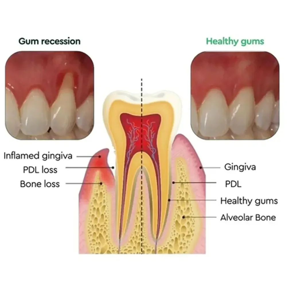 Gum Repair Drops Relieve Receding Gingival Swelling Gum Cleaning Care Oral Periodontal Hygiene Remove Yellow Tartar