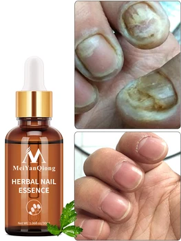 Лечение грибка для ногтей Уход за ногами эссенция отбеливание ног удаление грибка для ногтей гель против инфекции пароникья онихомикоз