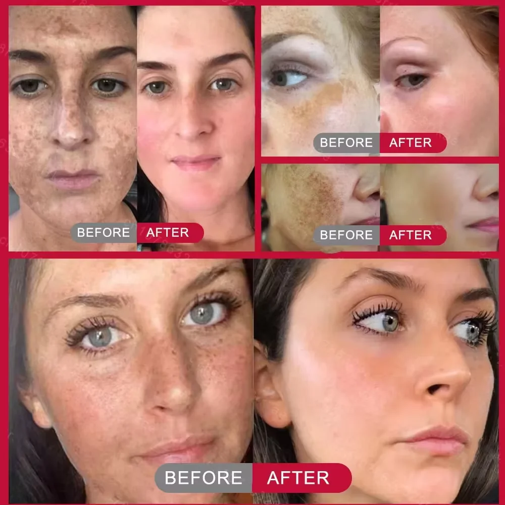 Niacinamide Whitening Freckles Serum Removal Melasma Dark Spots