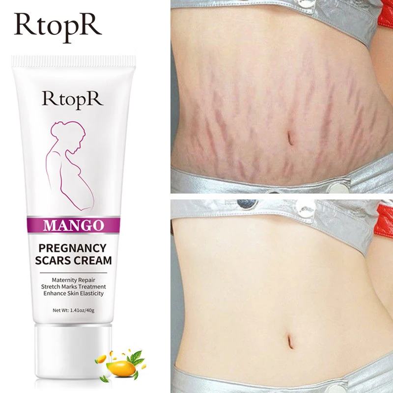 

Mango Remove Pregnancy Scars Acne Cream Stretch Marks Treatment Maternity Repair Anti-Aging Anti-Winkles Firming Body Creams