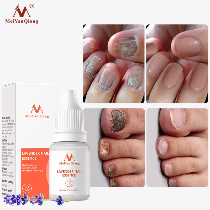 

Nail Treatment Essence Serum Care Hand And Foot Care Nail Fungus Treatment Essence Nails Restore Nail Shine Nail Repair Oil