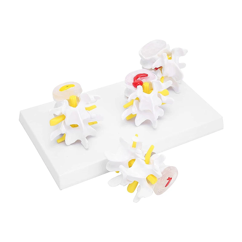 Anatomical Models 4-stage Pathological Human Lumbar Spine Anatomy Model Medical Science Teaching Resources