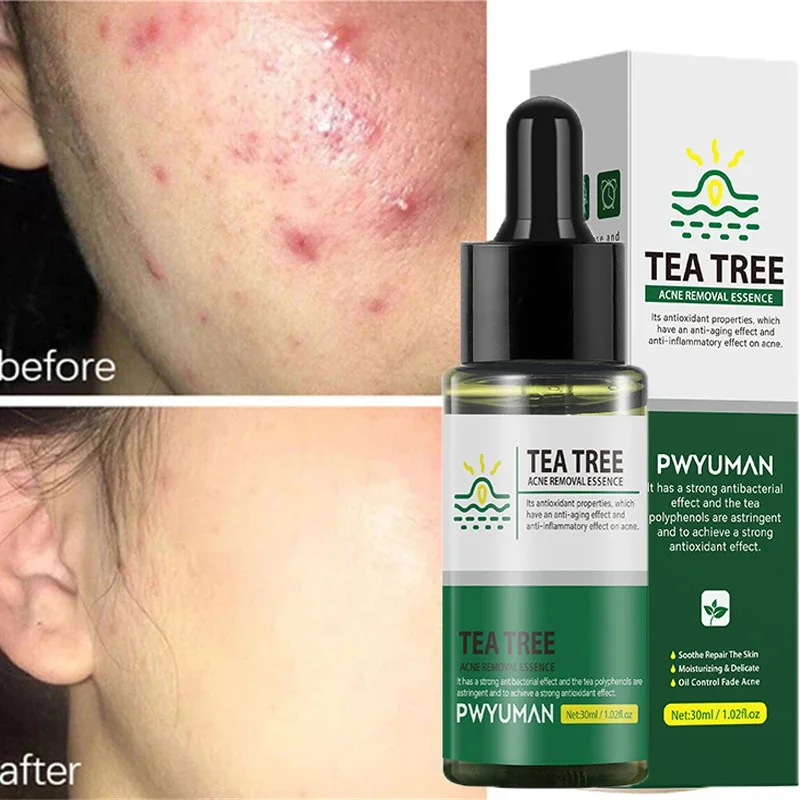 

Tea Tree Acne Treatment Serum Repair Dark Spots Scar Removal Pimples Shrink Pores Anti-Acne Oil Control Moisturizing Skin Care