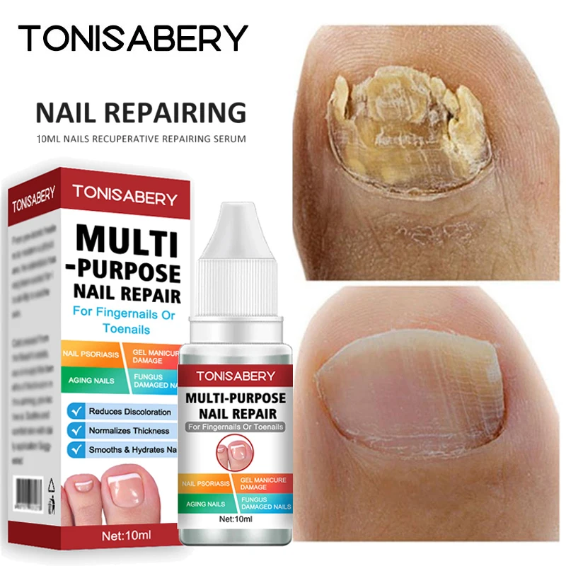Nail Fungal Treatment Serum Feet Toe Nail Fungus Removal Gel Anti