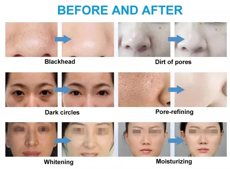 Professionelle 10-in-1-Hydro-Wasserschälmaschine, feuchtigkeitsspendende Hautaufhellung, Straffung, Tiefenreinigung, Diamant-Dermabrasionsmaschine – Detail 21