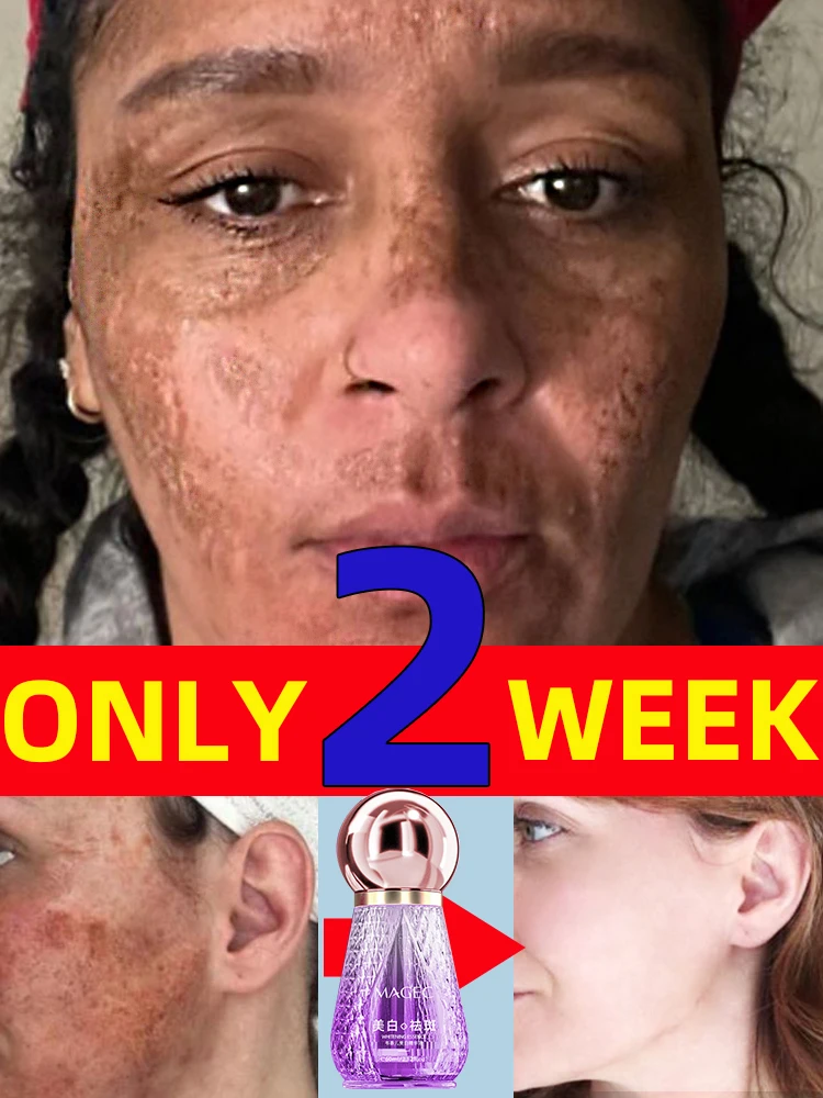 

Nicotinamide Whitening Freckle Removing Cream Effectively Remove Melasma Dark Spot Acne Marks Lightening Melanin Face Skin Care