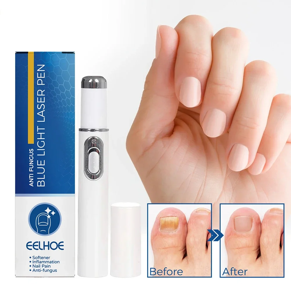 Nail Fungus Treatment Pen Anti-fungal Repair Pen Blue Light Laser Paronychia Nail Onychomycosis Painless Removal Care Tool