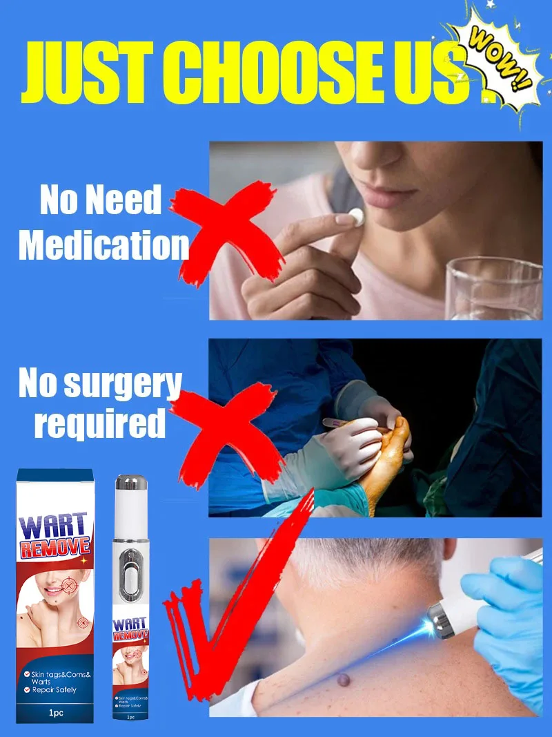 Blue Light Wart Removal Tool For Home Skincare Treatment_voghion.com