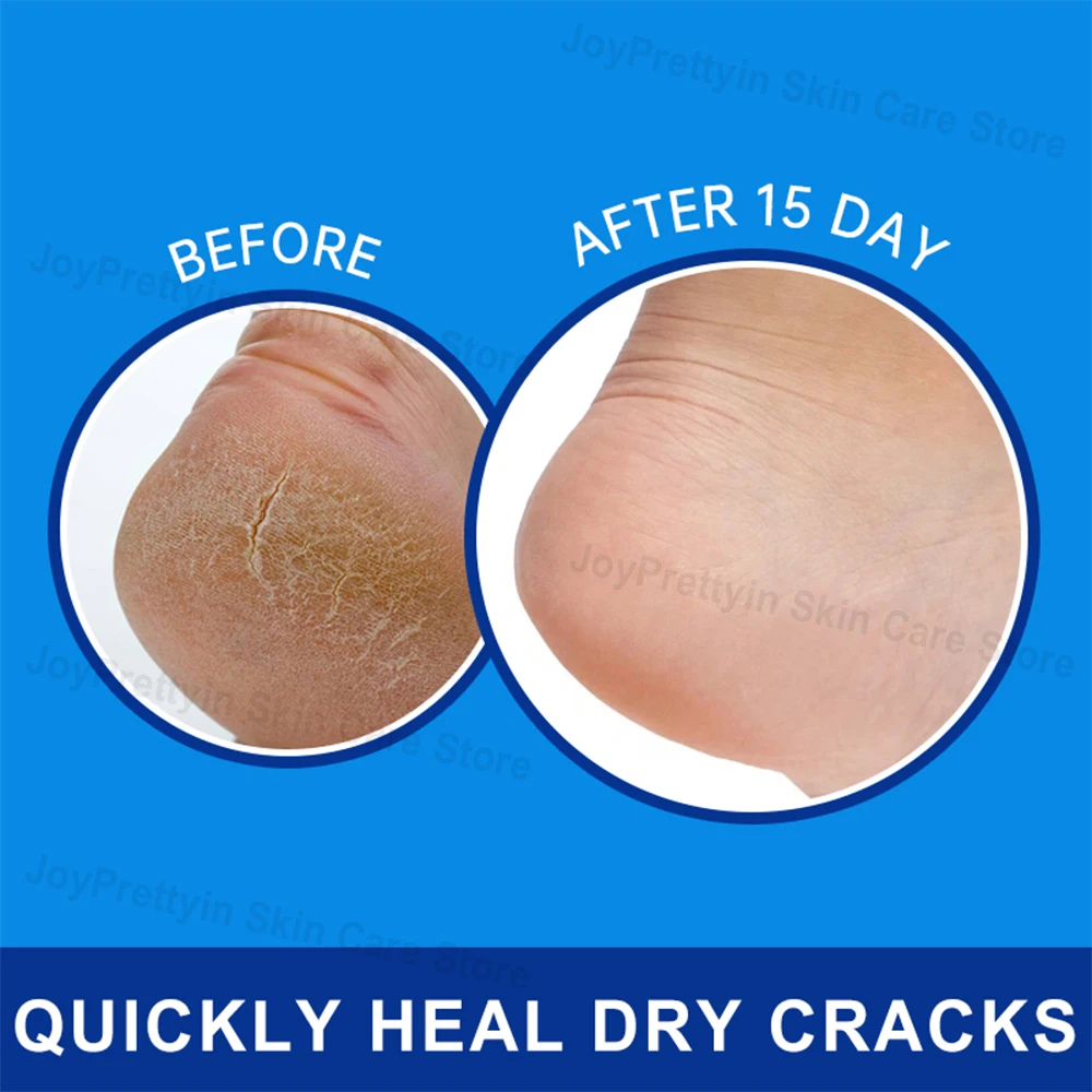 Foot Cream 42% Urea Coconut Oil for Feet & Hand Skin Care