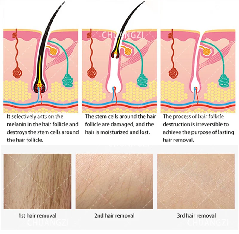 Ice Platinum Laser-Haarentfernungsgerät 3 Wellenlängen 755nm 808nm 1064nm Schmerzfreier Diodenlaser für Professionelle Schönheitssalons – Detail 9