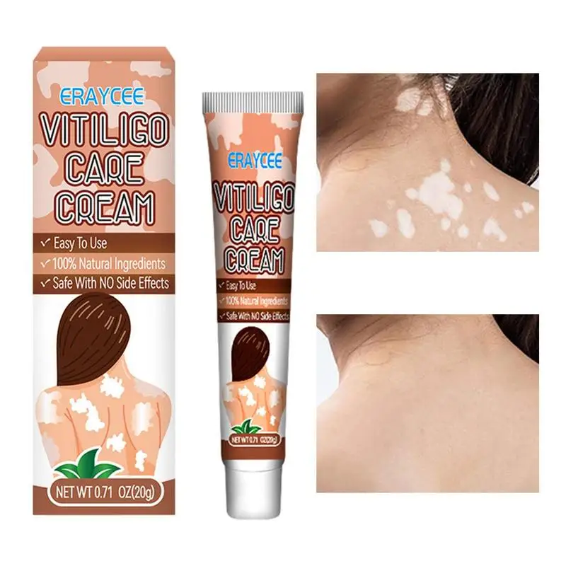 

Vitiligo Care Cream Effectively Remove Vitiligo Ointment Remove Ringworm White Spot Removal Skin Vitiligo Cream skin care