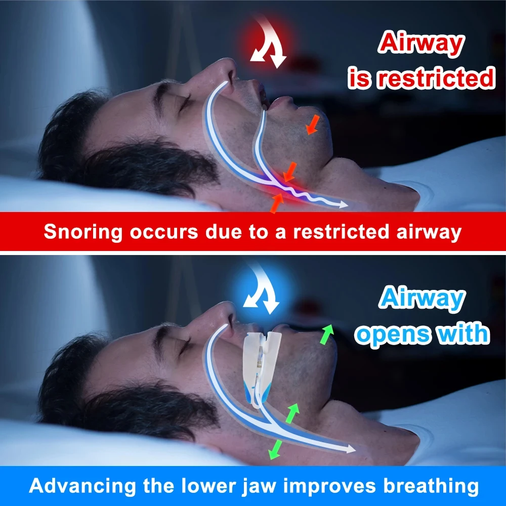 Anti Snoring Device Adjustable Anti Snore Mouth Guard