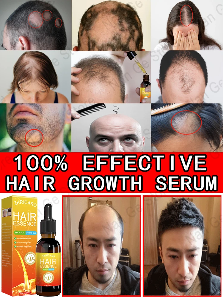 Unisex Hair Growth Oil Hair Loss Treatment Rapid Hair Growth Effective Baldness Repair Hereditary Postpartum  Loss