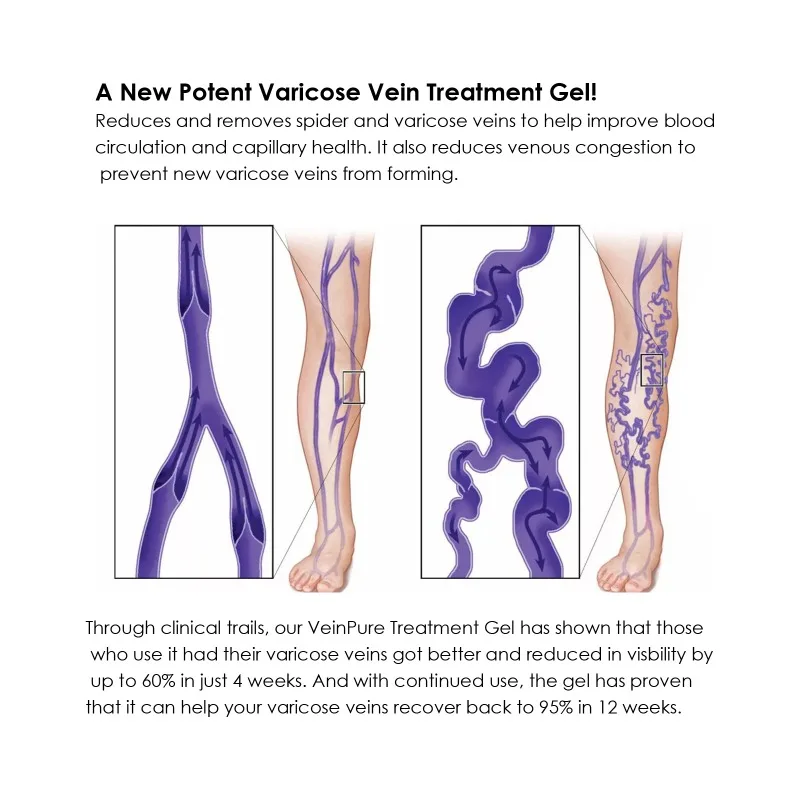 Varicose Veins Gel Phlebitis Worm Spider Legs Vessel Pain Professional Treatment Soothing Reduce Swelling Repair Cream