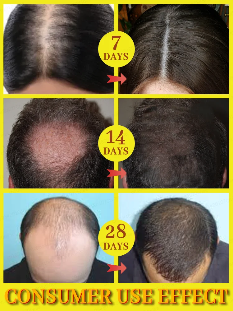 100% Natural Vegetable-based Hair Growth Essential Oil 3-day Hair Growth