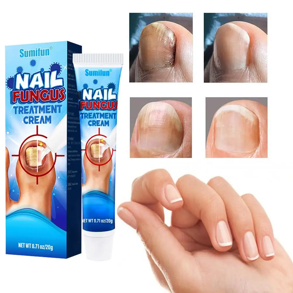 

20g Effective Nail Treatments Cream Nail Fungus Removal Cream Soft Ointment Toenail Nail Paronychia Onychomycosis Repair H1I3