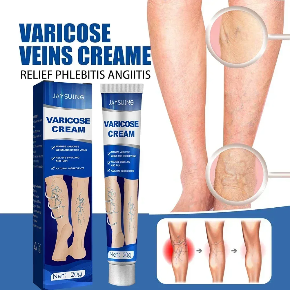 Varicose Vein Repair Cream Relieves Leg Bulge Pain Treatment Vasculitis Phlebitis