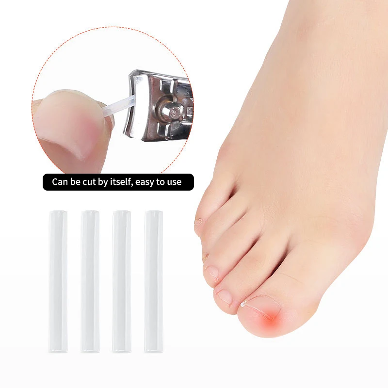 50pcs Ingrown Toenail Correction Tool Invisible Ingrown Toe Nail Treatment Pad Groove Straightening Clip Brace Foot Care Tool 4