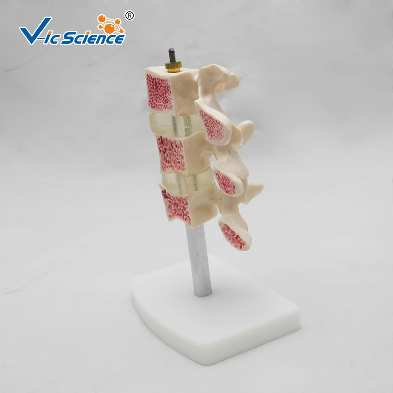 Life Szie Anatomical Human Cutaway Osteoporosis