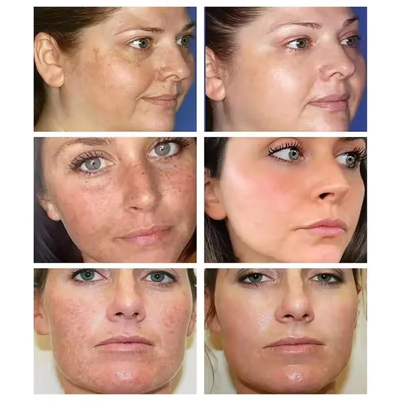 Fades Freckle Dark Spots Face Cream Niacinamide Whitening Cream Vitamin E Improve Dullness Fast Brighten Nourish Skin Care whitening body cream niacinamide serum facial cream