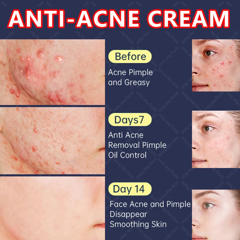

Acne Removal Face Cream Oil Control Anti-Acne Gel Treatment Acne Mark Skin Care Whitening Eliminate Pimples Facial Cream