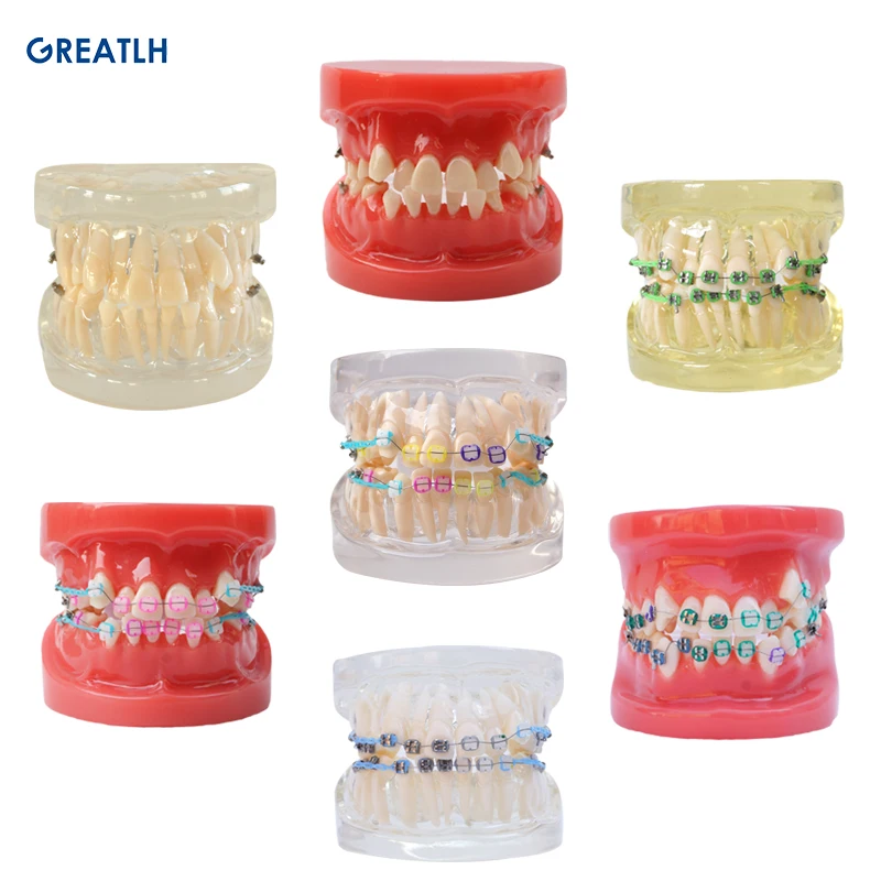 

Dental Teeth Model Orthodontic Model Metal Bracket Dental Orthodontic Model for Patient Communication 1pcs