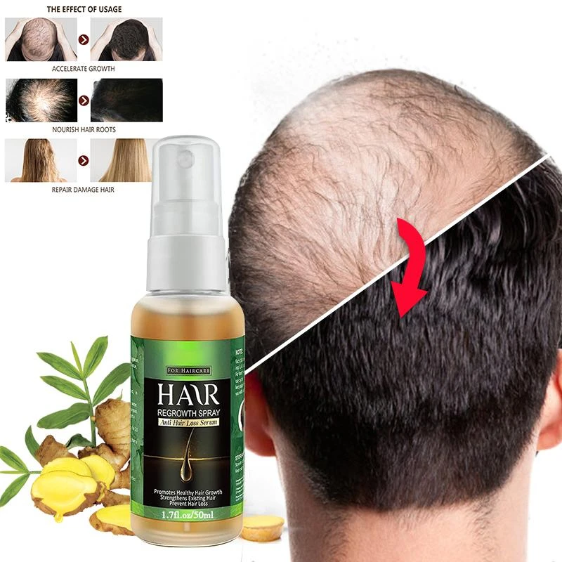 7DAYS Male and Female Ginger Hair Growth Spray Natural Anti Hair Loss  Products Rapid Growth Essence To Prevent Hair| | - AliExpress
