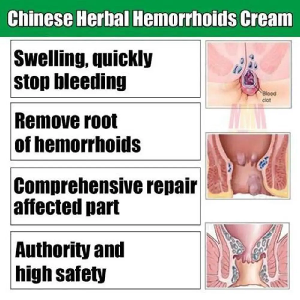 20g Pain Relief Hemorrhoid Ointment Internal And External Mixed Hemorrhoid Plant Formula Herbal Relieve Itching