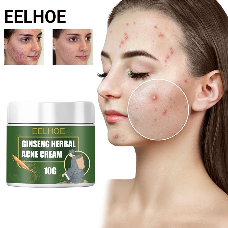 Effective Acne Removal Cream Remove Dark Spots Fade Acne Scars Shrink