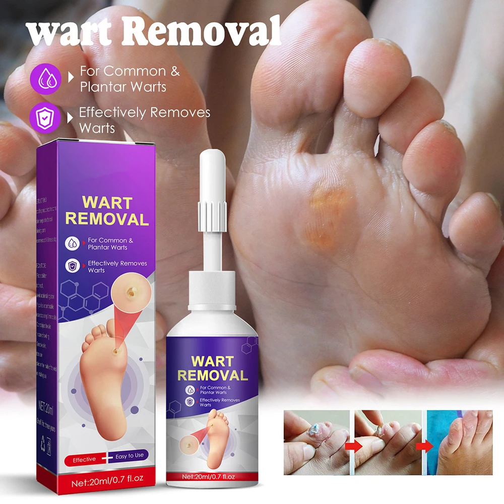 

20ML Corn Removal Liquids Body Warts Painless Remover Treatments Liquids for Face Neck Weight Loss Sour Patch Kids Pain Relie