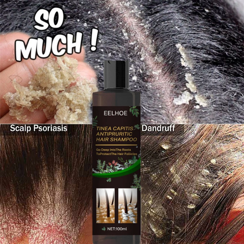 Seborrheic Dermatitis Scalp African American Hair