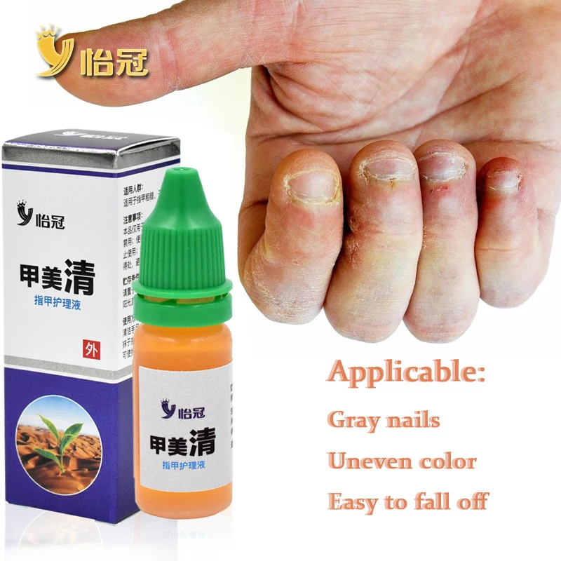 

Лечение ногтей от грибков, инфекция, онихомикоз, восстановление паронихии, эссенция для поврежденных ногтей для личного здорового ухода