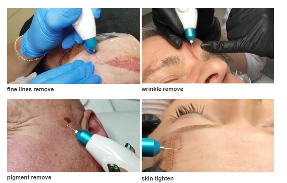 Fibroblast Plasma Pen Jet Plasma Eyelid Lifting Machine Wrinkle Removal Skin Rejuvenation Acne Remover K85 Cold